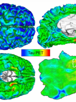 Làm sao tránh bệnh lẩn - Alzheimer